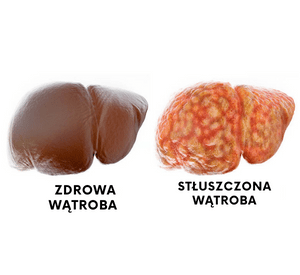 Niealkoholowym stłuszczeniu wątroby